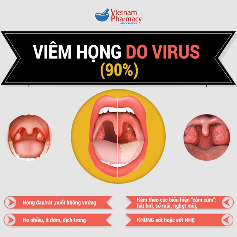 viêm họng do virus